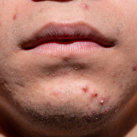 Cura naturale contro l'acne per la pelle maschile di InaEssentials