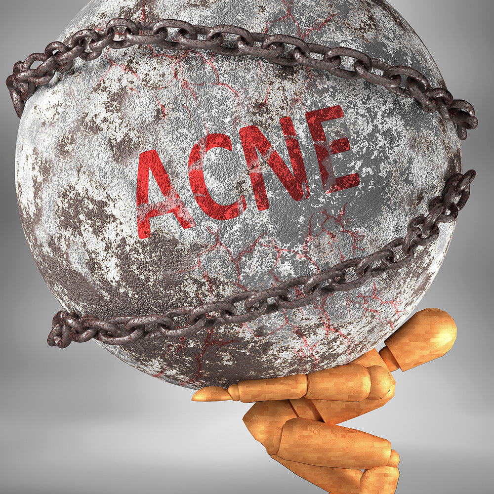 Acne e salute mentale: cura naturale delicata per la pelle di InaEssentials