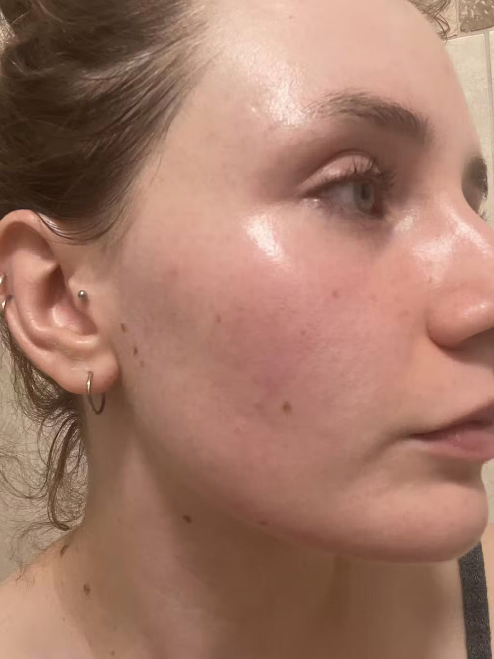 acne IT keep