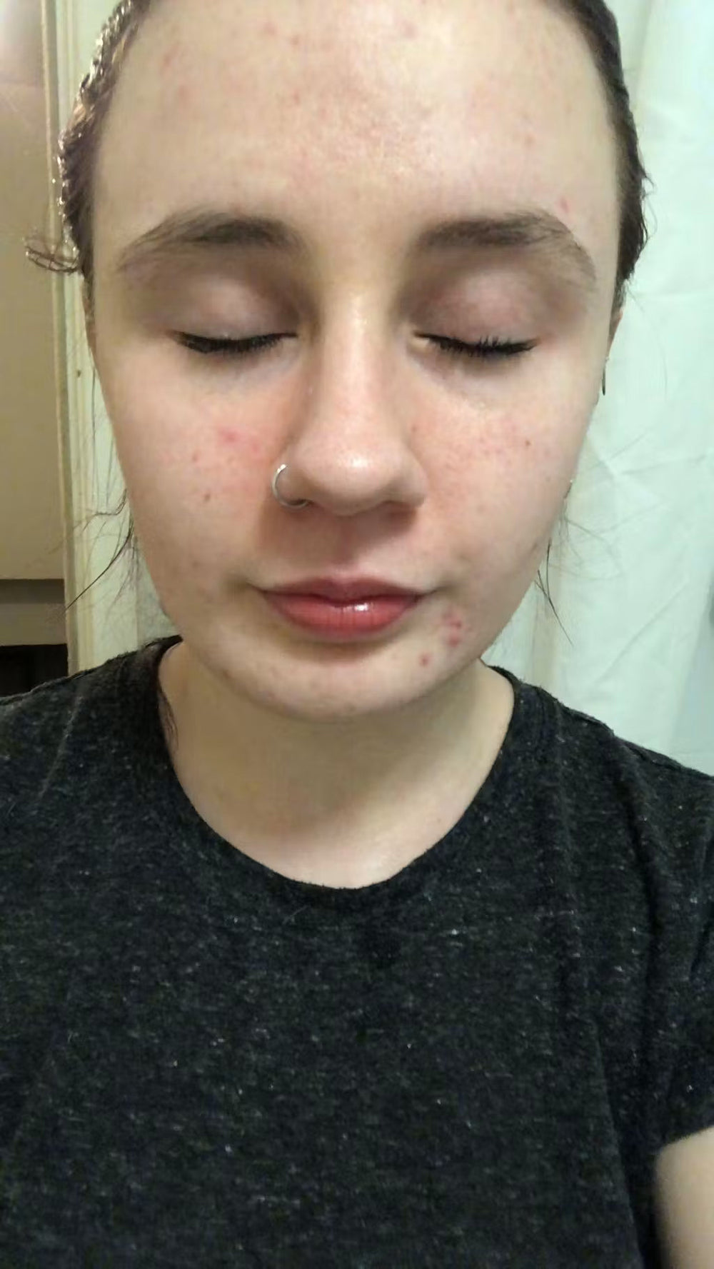 acne IT keep