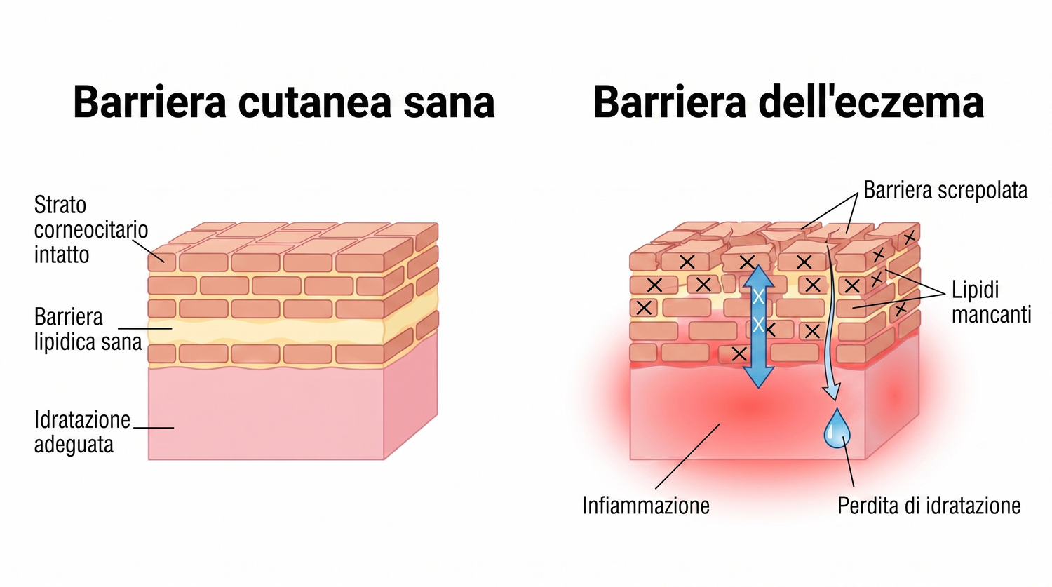 eczema_IT_skin_barrier_v2.png
